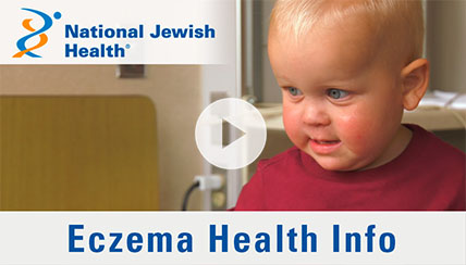 how is eczema treated video