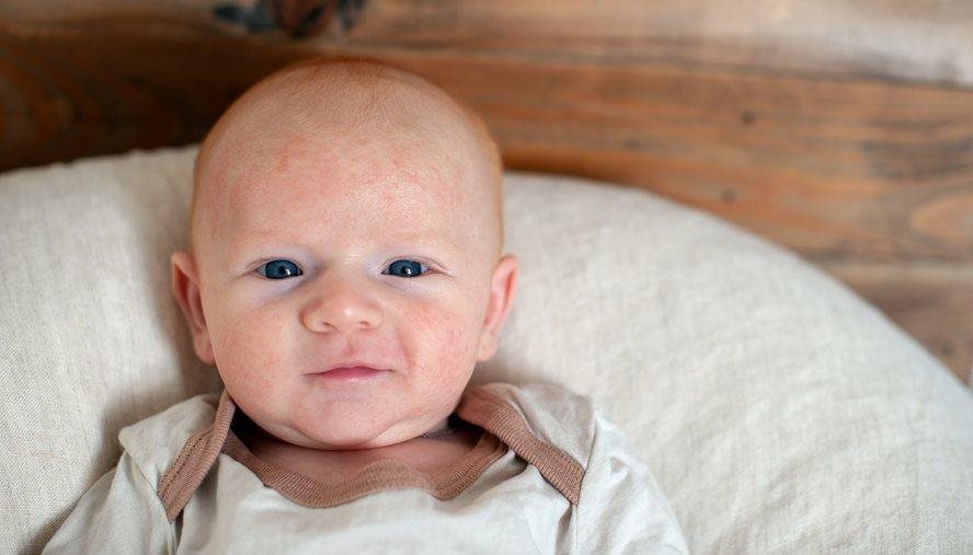 Infant with eczema