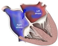 Intracardiac Shunts